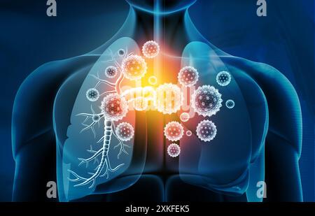 Infections pulmonaires virales, infection pulmonaire conepte. illustration 3d. Banque D'Images