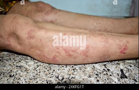 Infection fongique appelée tinea corporis dans la jambe de la femme asiatique. Ver annelé répandu sur le membre inférieur. Banque D'Images