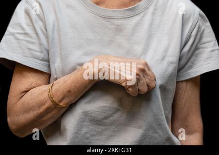 Contraction de Volkmann dans le membre supérieur gauche de la femme de l'Asie du Sud-est. C'est un raccourcissement permanent des muscles de l'avant-bras qui donne naissance à un po de type clawlike Banque D'Images