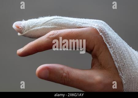 Doigt en maillet, empiler une attelle sur le majeur avec un bandage pour immobiliser la dernière phalange après un traumatisme articulaire Banque D'Images