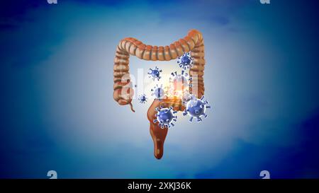 Conception médicale d'une infection du gros intestin Banque D'Images