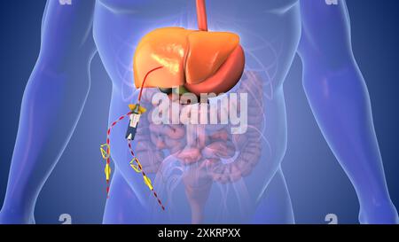 Chimiothérapie du cancer du foie concept médical Banque D'Images