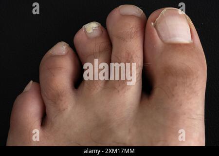 Ongle de pied infecté par un champignon isolé sur fond noir Banque D'Images