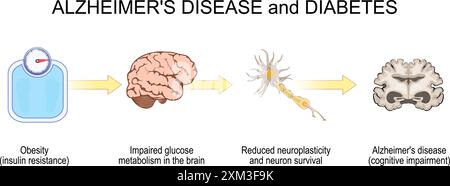 Diabète et progression de la maladie d'Alzheimer. De l'obésité, de la résistance à l'insuline, au déclin cognitif et à la maladie d'Alzheimer. illustration vectorielle Illustration de Vecteur