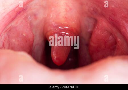 Inflammation de la luette dans la cavité buccale due à une infection et à un virus. Le traitement de la maladie est uvulite. Gorge rouge due à la maladie, macro Banque D'Images