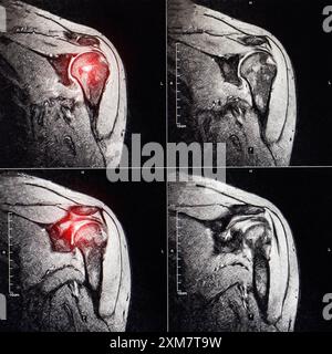 Imagerie IRM de l'articulation de l'épaule après fracture et luxation. Fracture d'empreinte de la tête humérale. Blessure à l'épaule, entorse, synovite. Le rouge Banque D'Images