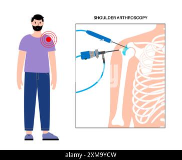 Illustration d'un procédé d'arthroscopie de l'épaule. Il s'agit d'une procédure de diagnostic et de traitement des problèmes articulaires. Un chirurgien insère un tube étroit attaché à une caméra vidéo à fibre optique à travers une petite incision. Banque D'Images