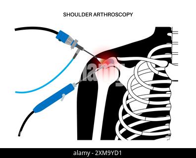 Illustration d'un procédé d'arthroscopie de l'épaule. Il s'agit d'une procédure de diagnostic et de traitement des problèmes articulaires. Un chirurgien insère un tube étroit attaché à une caméra vidéo à fibre optique à travers une petite incision. Banque D'Images