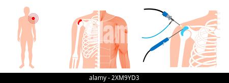 Illustration d'un procédé d'arthroscopie de l'épaule. Il s'agit d'une procédure de diagnostic et de traitement des problèmes articulaires. Un chirurgien insère un tube étroit attaché à une caméra vidéo à fibre optique à travers une petite incision. Banque D'Images