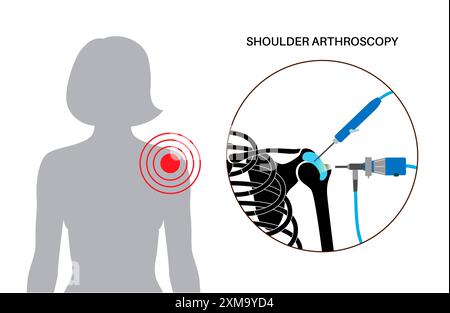 Illustration d'un procédé d'arthroscopie de l'épaule. Il s'agit d'une procédure de diagnostic et de traitement des problèmes articulaires. Un chirurgien insère un tube étroit attaché à une caméra vidéo à fibre optique à travers une petite incision. Banque D'Images