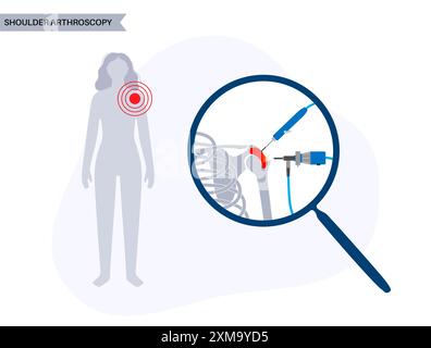 Illustration d'un procédé d'arthroscopie de l'épaule. Il s'agit d'une procédure de diagnostic et de traitement des problèmes articulaires. Un chirurgien insère un tube étroit attaché à une caméra vidéo à fibre optique à travers une petite incision. Banque D'Images