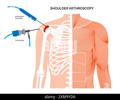 Illustration d'un procédé d'arthroscopie de l'épaule. Il s'agit d'une procédure de diagnostic et de traitement des problèmes articulaires. Un chirurgien insère un tube étroit attaché à une caméra vidéo à fibre optique à travers une petite incision. Banque D'Images