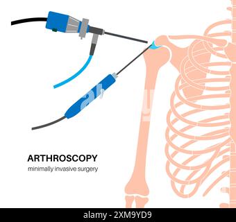 Illustration d'un procédé d'arthroscopie de l'épaule. Il s'agit d'une procédure de diagnostic et de traitement des problèmes articulaires. Un chirurgien insère un tube étroit attaché à une caméra vidéo à fibre optique à travers une petite incision. Banque D'Images