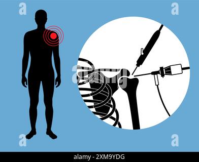 Illustration d'un procédé d'arthroscopie de l'épaule. Il s'agit d'une procédure de diagnostic et de traitement des problèmes articulaires. Un chirurgien insère un tube étroit attaché à une caméra vidéo à fibre optique à travers une petite incision. Banque D'Images