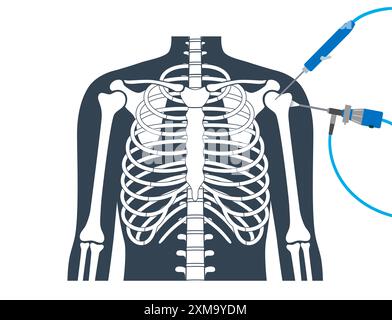 Illustration d'un procédé d'arthroscopie de l'épaule. Il s'agit d'une procédure de diagnostic et de traitement des problèmes articulaires. Un chirurgien insère un tube étroit attaché à une caméra vidéo à fibre optique à travers une petite incision. Banque D'Images