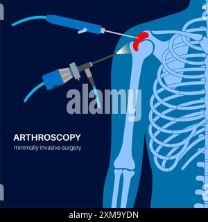 Illustration d'un procédé d'arthroscopie de l'épaule. Il s'agit d'une procédure de diagnostic et de traitement des problèmes articulaires. Un chirurgien insère un tube étroit attaché à une caméra vidéo à fibre optique à travers une petite incision. Banque D'Images