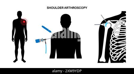 Illustration d'un procédé d'arthroscopie de l'épaule. Il s'agit d'une procédure de diagnostic et de traitement des problèmes articulaires. Un chirurgien insère un tube étroit attaché à une caméra vidéo à fibre optique à travers une petite incision. Banque D'Images