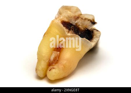 Dent de sagesse enlevée avec des caries isolées sur un fond blanc, gros plan macro. Dent numéro huit, photo très détaillée Banque D'Images