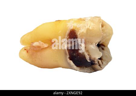 Dent de sagesse enlevée avec des caries isolées sur un fond blanc, gros plan macro. Dent numéro huit, photo très détaillée Banque D'Images