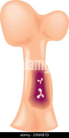 myélome multiple section transversale des os Illustration de Vecteur