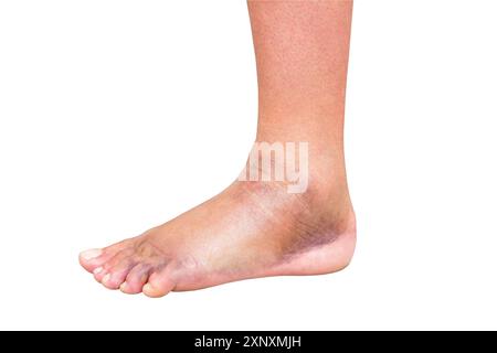 pied de femme malade avec hématome gros plan, isolé sur fond blanc avec chemin de découpage Banque D'Images