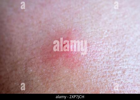 Acné inflammatoire avec tache rouge sur le visage gros plan Banque D'Images