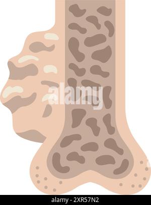 myélome multiple section transversale des os Illustration de Vecteur