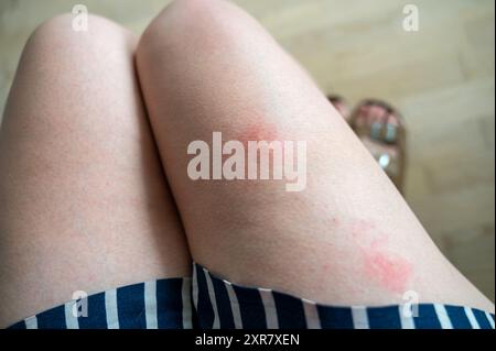 Vue rapprochée des jambes d'une personne portant un short, avec deux grandes piqûres de moustiques rouges. Morsures enflammées et clairement visibles contre la peau Banque D'Images