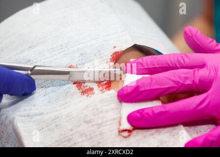 Médecin suturant un patient lors d'une petite chirurgie. Dermatologue réalisant une ablation d'une lésion cutanée bénigne sur le visage d'un jeune homme. Banque D'Images