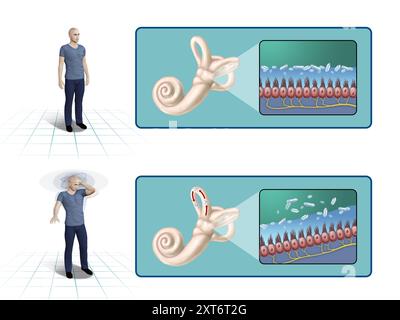 Vertige positionnel paroxystique Bénin. Vertiges par problèmes de l'oreille interne. Illustration numérique, rendu 3D. Banque D'Images