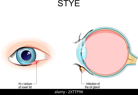 Style. Coupe transversale d'un globe oculaire humain avec infection de la glande huileuse. Gros plan de l'œil avec Hordeolum de la paupière inférieure. Illustration vectorielle Illustration de Vecteur