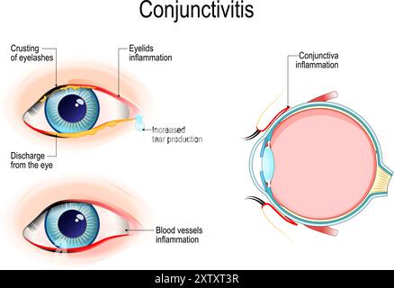 Conjonctivites. Oeil rose. Coupe transversale d'une paupière humaine avec inflammation de la conjonctive. Œil de vue externe avec croûte de cils, écoulement de Illustration de Vecteur