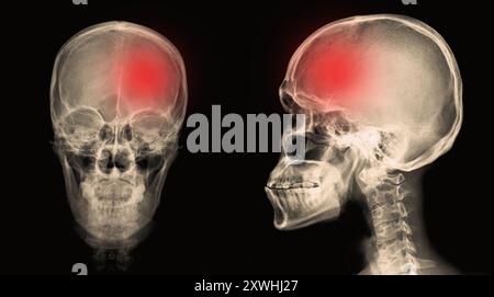 crâne radiographique de l'homme avec zone d'accident vasculaire cérébral ou accident vasculaire cérébral hémorragique. Banque D'Images