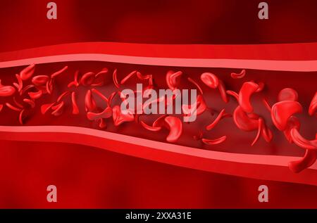 Anémie falciforme - vue isométrique illustration 3D. Banque D'Images