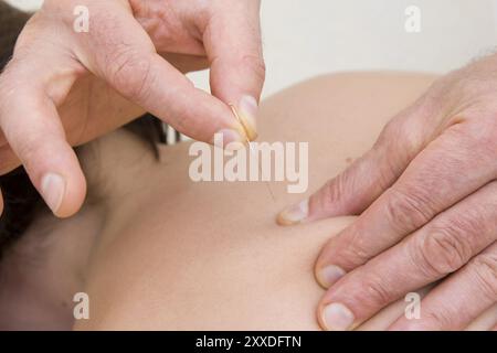 Placez les aiguilles d'acupuncture dans la zone faciale d'une femme Banque D'Images