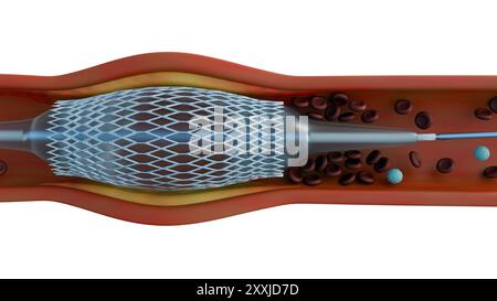 Un rendu 3D d'un stent à l'intérieur d'un capillaire sanguin permet de visualiser la procédure. L'angioplastie est une procédure pour ouvrir des vaisseaux sanguins rétrécis ou bloqués. Banque D'Images