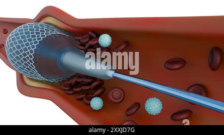 Un rendu 3D d'un stent à l'intérieur d'un capillaire sanguin permet de visualiser la procédure. L'angioplastie est une procédure pour ouvrir des vaisseaux sanguins rétrécis ou bloqués. Banque D'Images