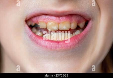 Bouche d'un homme aux dents jaunes tordues gros plan. Problème dentaire. Dents jaunes d'une femme avant le traitement et le blanchiment des dents, couronnes dentaires Banque D'Images