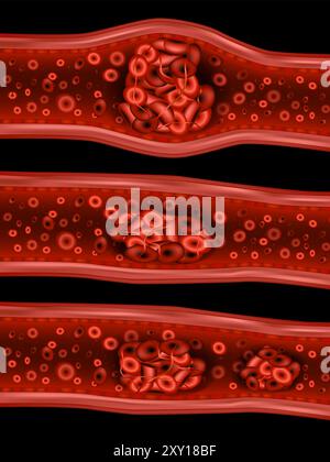 Illustration des types de thrombus. Types de caillots sanguins. Illustration de Vecteur