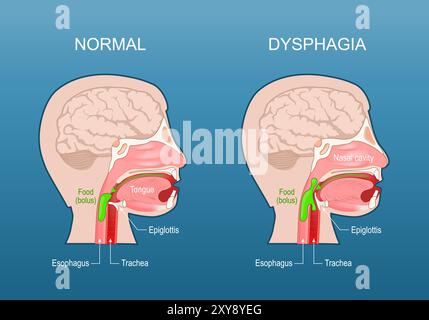 Dysphagie. Difficulté à avaler. Dysphagie oesophagienne. Risque d'aspiration. Coupe transversale d'une tête humaine avec œsophage, trachée, cavité nasale, langue, Illustration de Vecteur