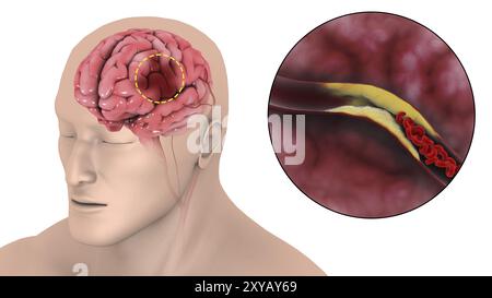 Illustration médicale d'un accident vasculaire cérébral ischémique, où l'apport sanguin à une partie du cerveau est diminué Banque D'Images