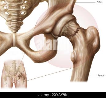 Anatomie de la fracture de hanche Banque D'Images