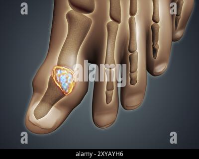 Image conceptuelle de la goutte dans le gros orteil. La goutte est une forme d'arthrite inflammatoire qui provoque une douleur soudaine et intense, un gonflement et une sensibilité articulaire Banque D'Images