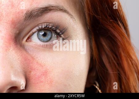 Gros plan d'une jeune femme à la peau rouge, éprouvant un inconfort dû à la rosacée Banque D'Images