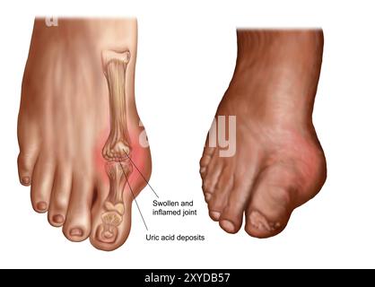 Anatomie d'un pied gonflé Banque D'Images