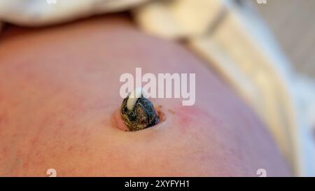 Un moignon de cordon ombilical pour nourrissons est soigneusement nettoyé avec un coton-tige Banque D'Images