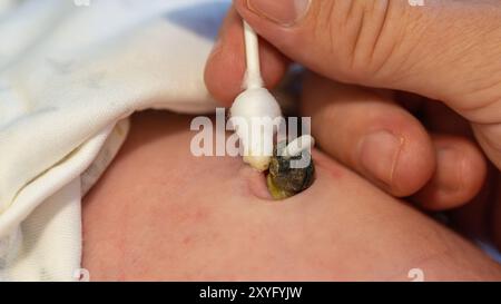 Un moignon de cordon ombilical pour nourrissons est soigneusement nettoyé avec un coton-tige Banque D'Images