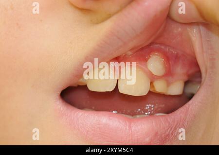 Dents dans la bouche de l'enfant ouvertes. Petite bouche de dents d'enfant sur le visage macro Banque D'Images