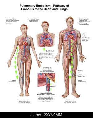 Embolie pulmonaire, voie d'embolie au coeur et aux poumons Banque D'Images