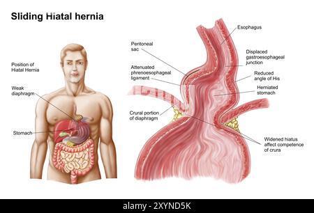 Ilustration médicale d'une hernie hiatale de la partie supérieure de l'estomac dans le thorax Banque D'Images